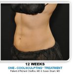 Coolsculpting Before & After Patient #4798