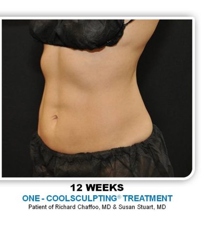 Coolsculpting Before & After Patient #4798