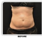 Coolsculpting Before & After Patient #4801