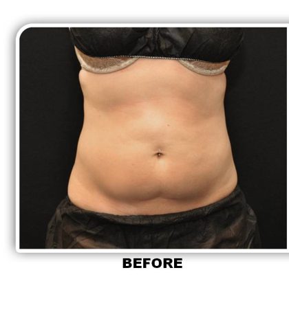 Coolsculpting Before & After Patient #4801