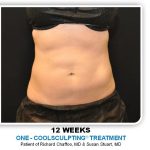 Coolsculpting Before & After Patient #4801