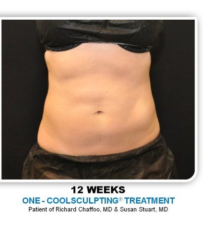 Coolsculpting Before & After Patient #4801