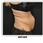 Coolsculpting Before & After Patient #4804