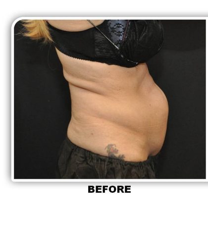 Coolsculpting Before & After Patient #4804