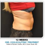 Coolsculpting Before & After Patient #4804