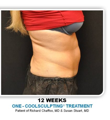 Coolsculpting Before & After Patient #4804