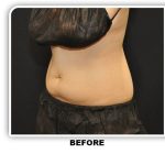 Coolsculpting Before & After Patient #4811