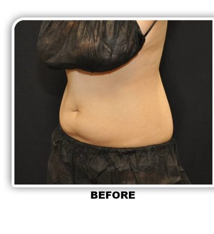 Coolsculpting Before & After Patient #4811