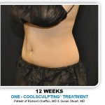 Coolsculpting Before & After Patient #4811