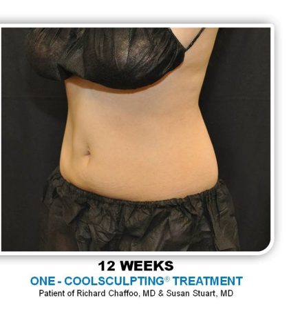 Coolsculpting Before & After Patient #4811