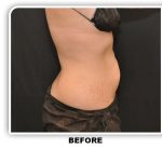 Coolsculpting Before & After Patient #4811