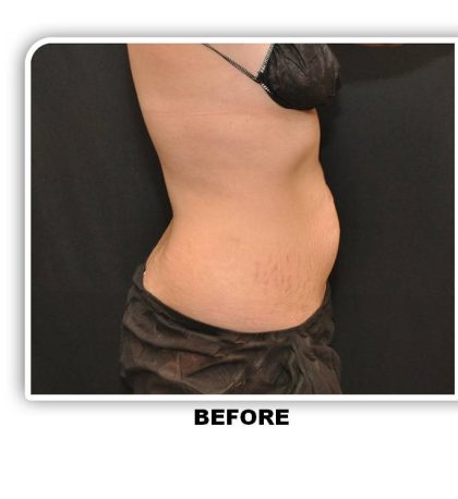 Coolsculpting Before & After Patient #4811