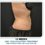 Coolsculpting Before & After Patient #4811