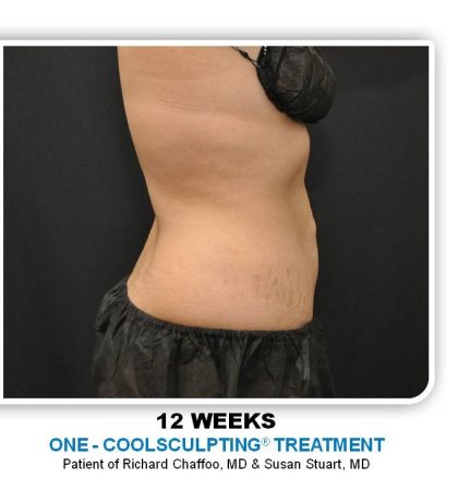 Coolsculpting Before & After Patient #4811