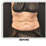 Coolsculpting Before & After Patient #4816