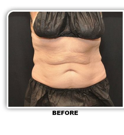 Coolsculpting Before & After Patient #4816