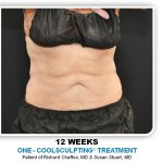 Coolsculpting Before & After Patient #4816