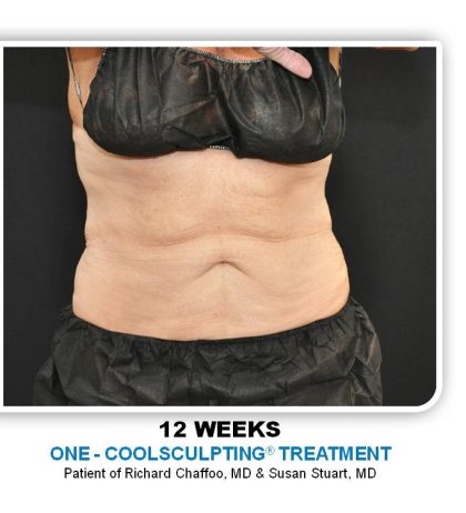 Coolsculpting Before & After Patient #4816