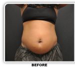 Coolsculpting Before & After Patient #4819