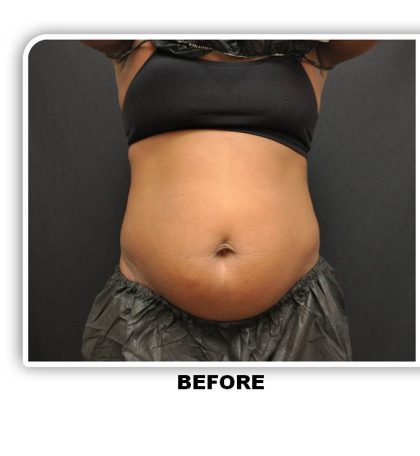 Coolsculpting Before & After Patient #4819
