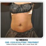 Coolsculpting Before & After Patient #4819