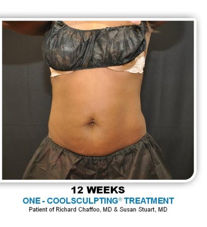 Coolsculpting Before & After Patient #4819