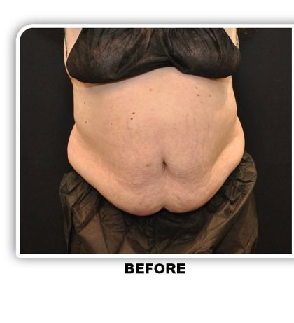 Coolsculpting Before & After Patient #4822