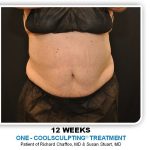 Coolsculpting Before & After Patient #4822