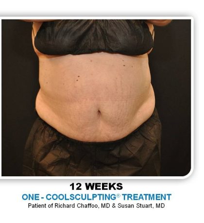 Coolsculpting Before & After Patient #4822