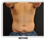 Coolsculpting Before & After Patient #4825