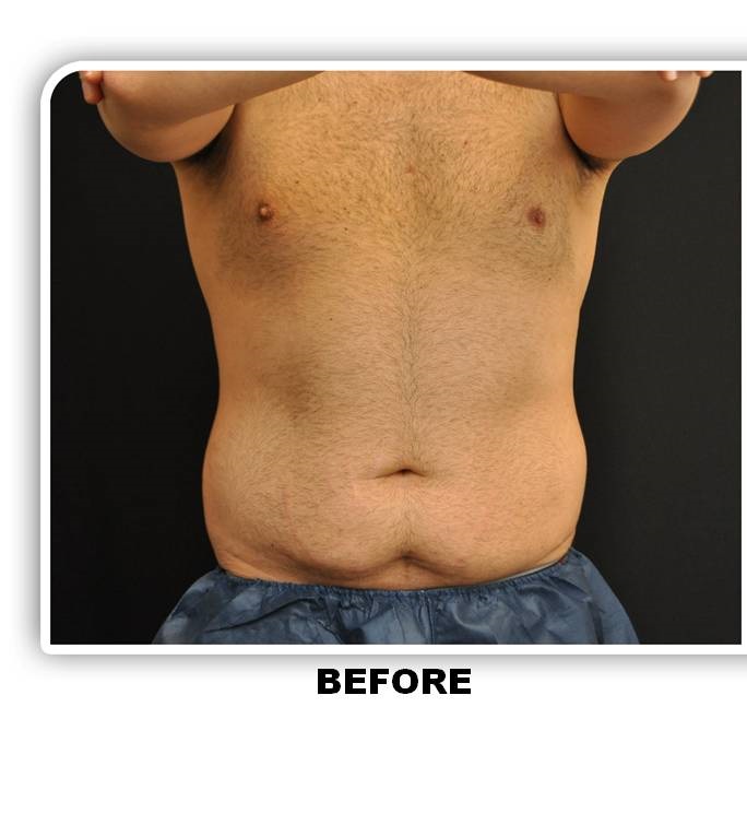 Coolsculpting Before & After Patient #4825