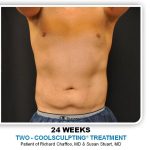 Coolsculpting Before & After Patient #4825