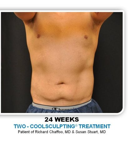 Coolsculpting Before & After Patient #4825