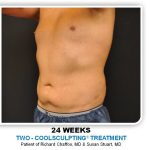 Coolsculpting Before & After Patient #4825
