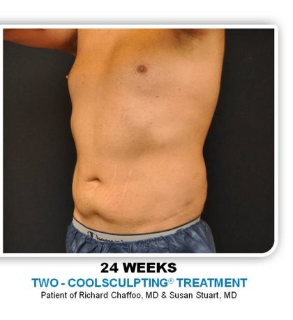 Coolsculpting Before & After Patient #4825