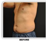 Coolsculpting Before & After Patient #4825