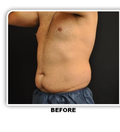 Coolsculpting Before & After Patient #4825