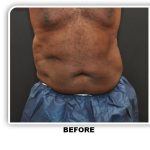 Liposuction Before & After Patient #4361