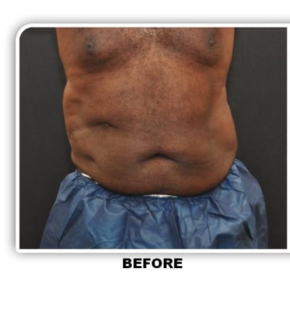 Liposuction Before & After Patient #4361