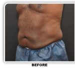 Liposuction Before & After Patient #4361