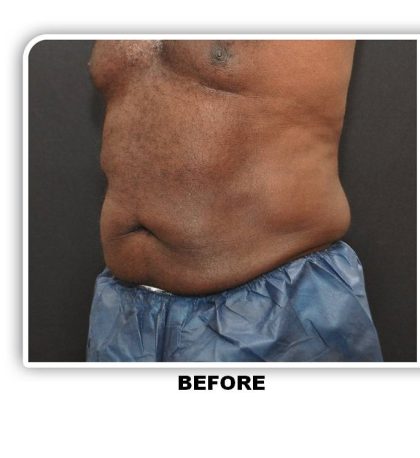 Liposuction Before & After Patient #4361