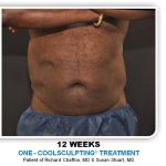 Liposuction Before & After Patient #4361