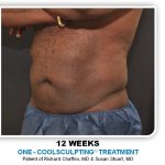 Liposuction Before & After Patient #4361