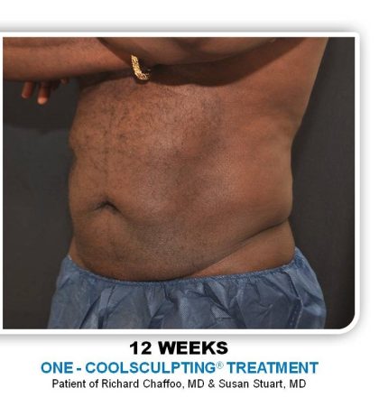 Liposuction Before & After Patient #4361