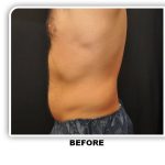 Coolsculpting Before & After Patient #4830