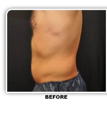 Coolsculpting Before & After Patient #4830