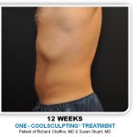 Coolsculpting Before & After Patient #4830