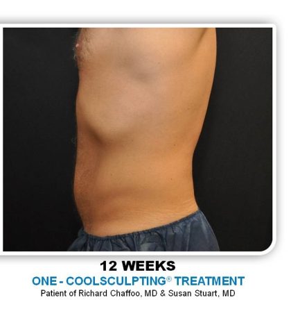 Coolsculpting Before & After Patient #4830