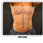 Coolsculpting Before & After Patient #4830