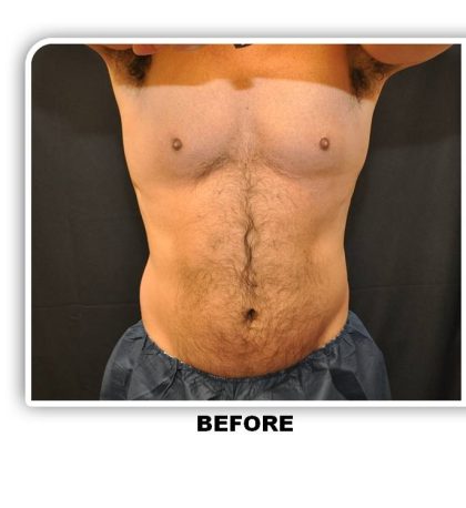 Coolsculpting Before & After Patient #4830